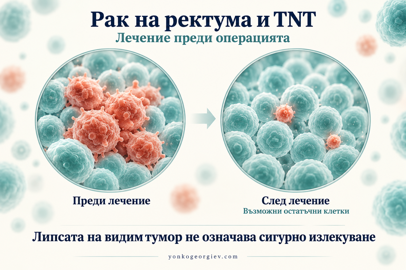 Рак на ректума: защо понякога лечението започва преди операцията?